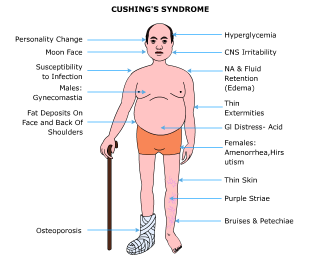 Cushing Syndrome: Causes, Symptoms & Treatment